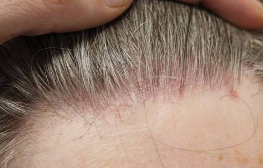 Scalp Inflammation and Its Impact on Hair Loss- Causes and Treatments