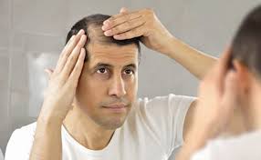 historical figures who hid hair loss